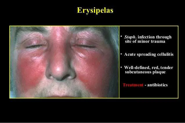 03 diffuse eyelid diseases