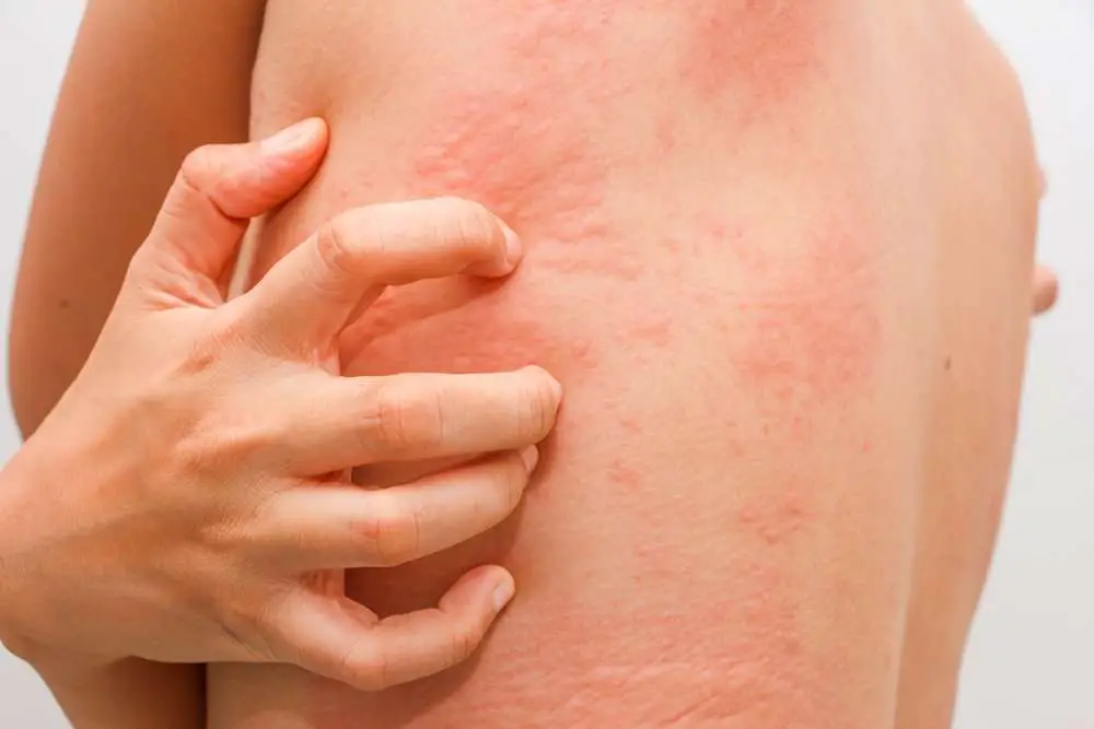 10 Symptoms of Sulfa Allergies