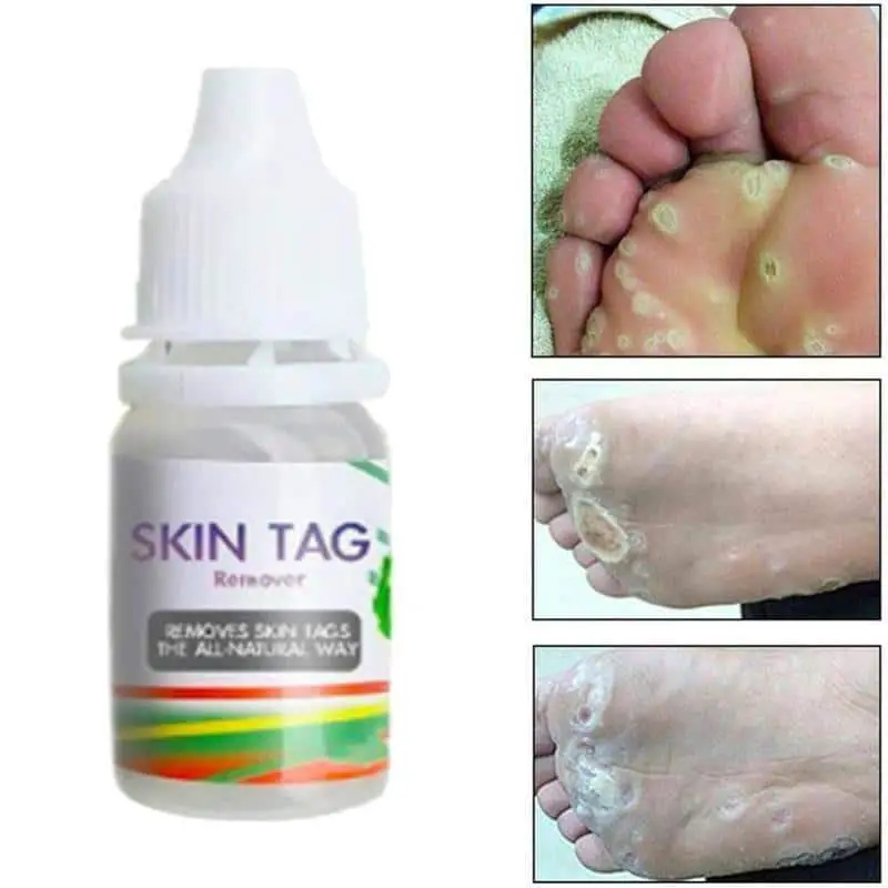 10ML Body Warts Treatment Cream Skin Tag Remover Foot Corn Removal ...