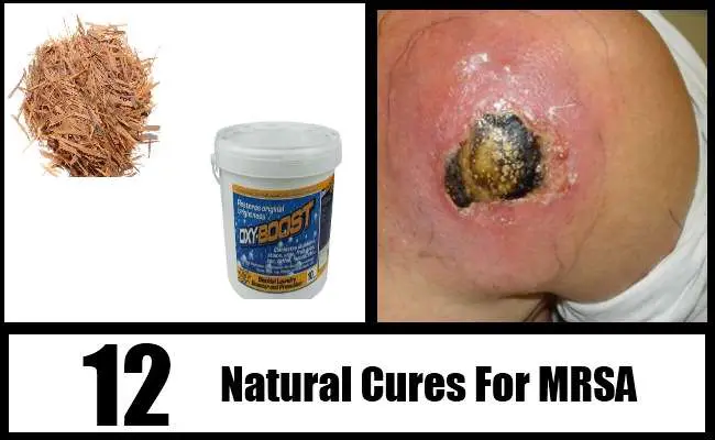 12 Effective Natural Cures For MRSA
