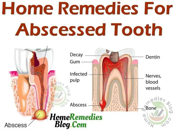 15 Effective Home Remedies For Gum Abscess Treatment