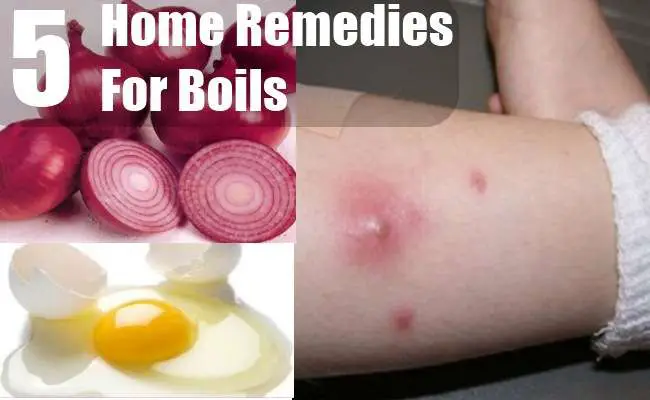 5 Effective Home Remedies for Boils