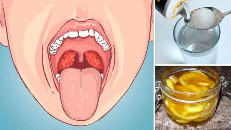 5 Strep Throat Home Remedies to Kick Strep Throat Without ...