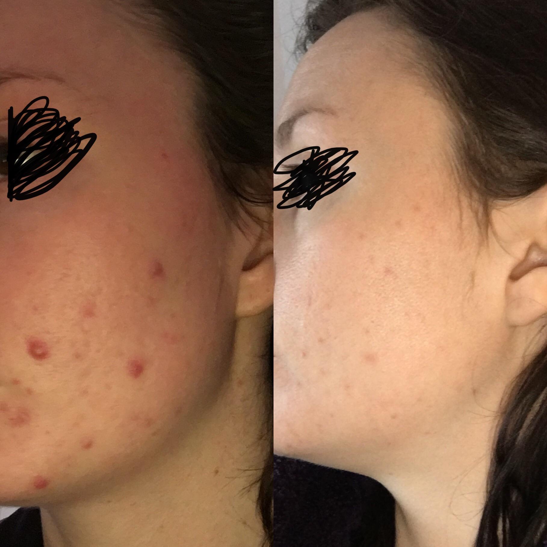 6 week progress after stopping meds (antibiotics) and using 100% ...