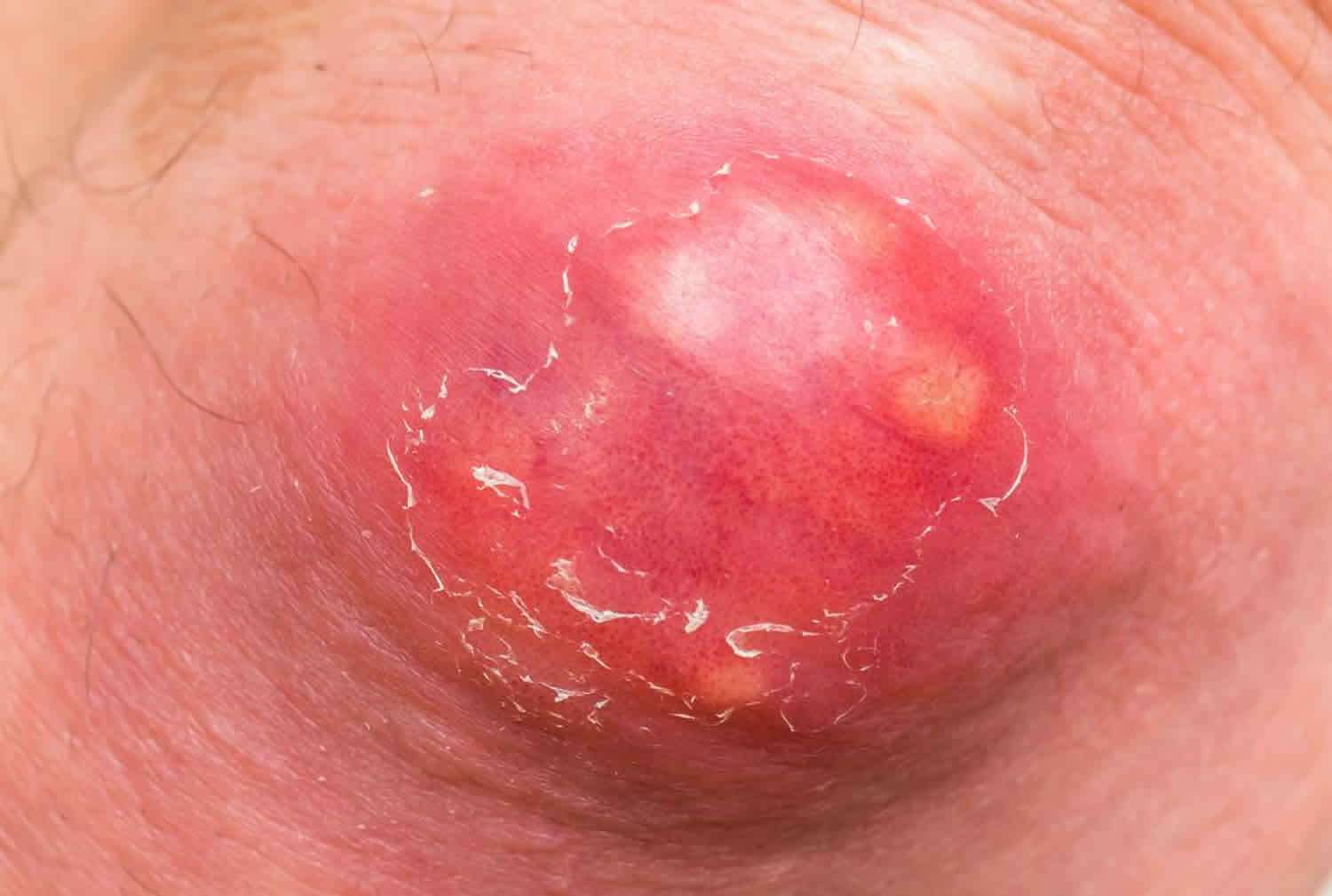 Abscess causes, signs, symptoms, types and how to treat an ...