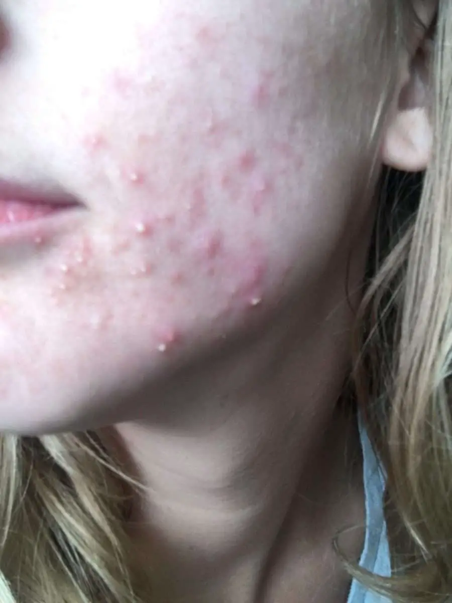[acne] Save this face  fungal acne? I