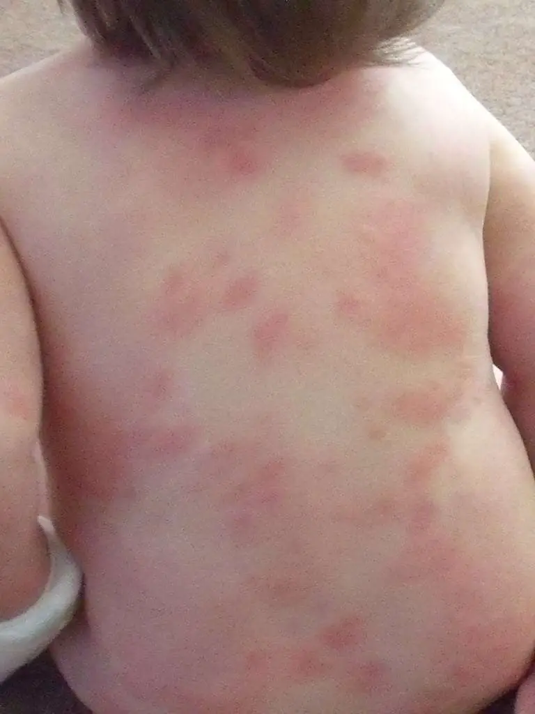 Allergic erythema multiforme reaction to amoxicillin in children and ...