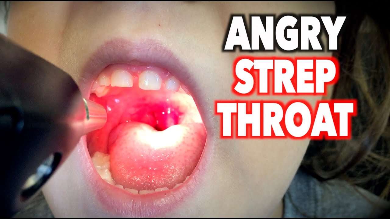ANGRY STREP THROAT After Antibiotics!