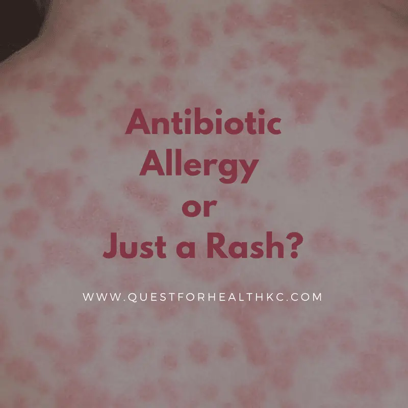 Antibiotic Allergy or Just a Rash?