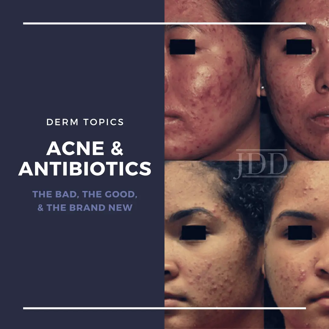 Antibiotics and Acne: the Bad, the Good, and the Brand New