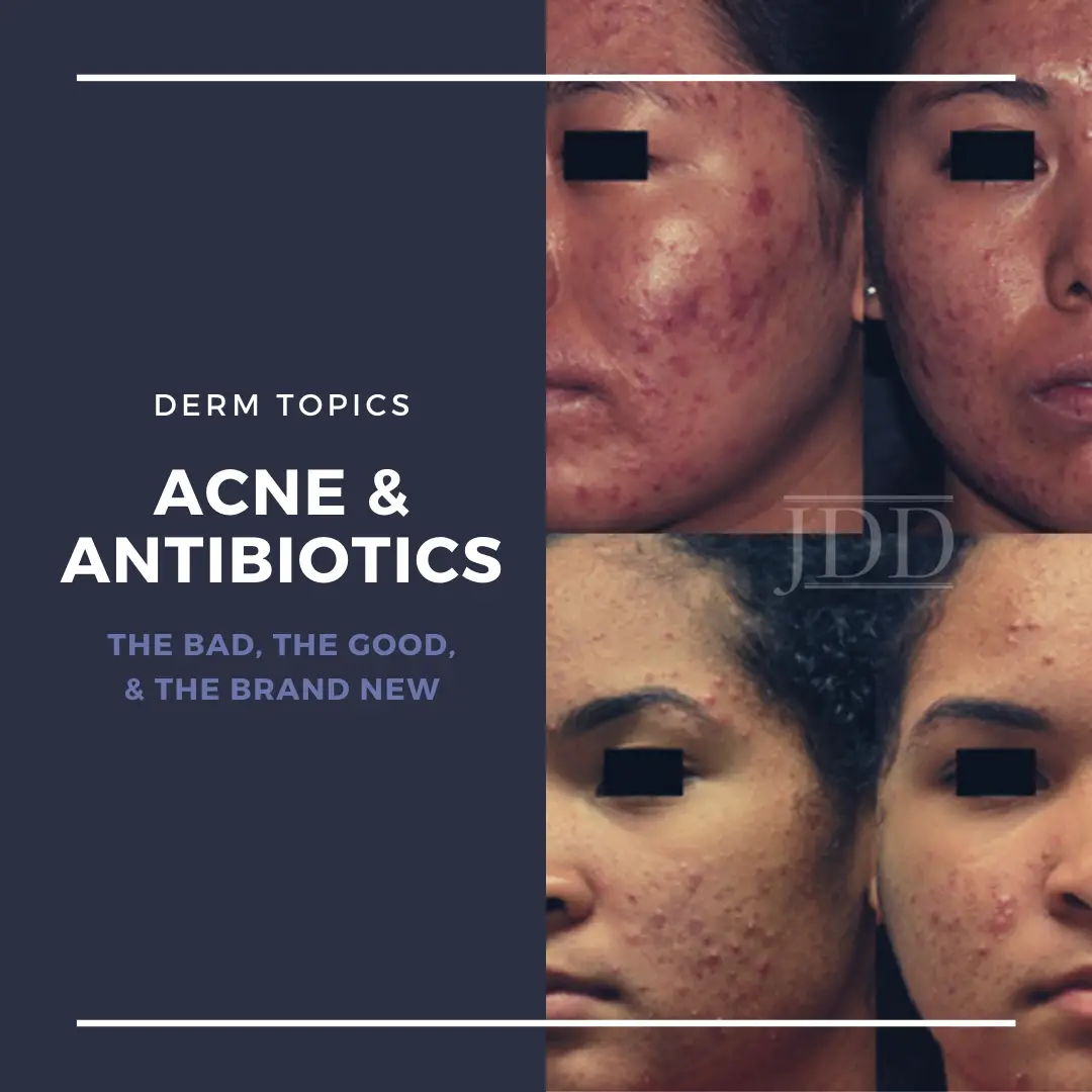 Antibiotics and Acne: the Bad, the Good, and the Brand New ...