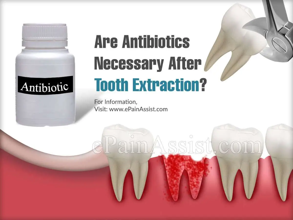 Are Antibiotics Necessary After Tooth Extraction?