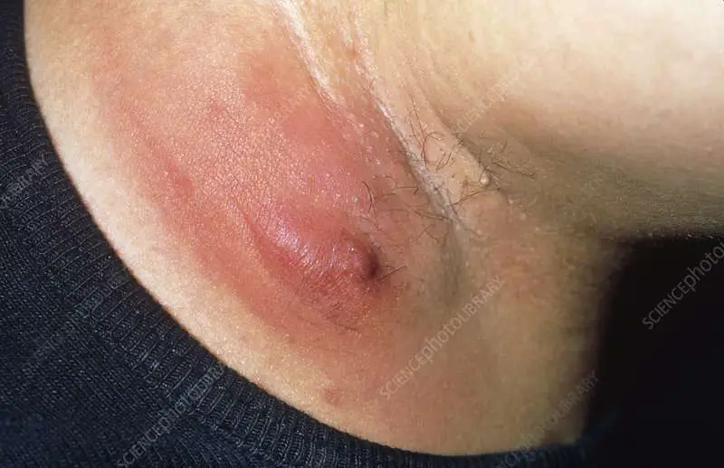 Armpit Staph Infection Pictures