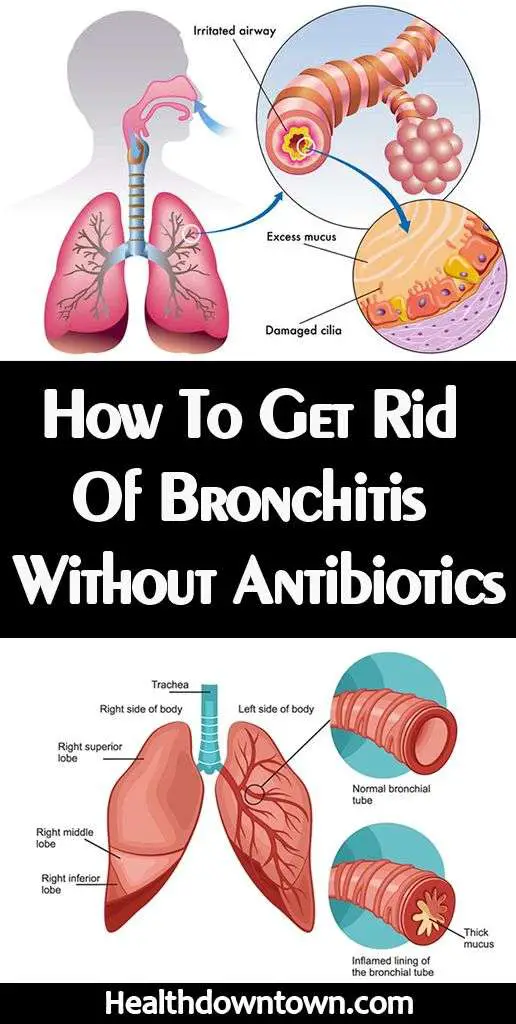 âSince Foreverâ? Remedies To Get Rid Of Bronchitis Without Antibiotics ...
