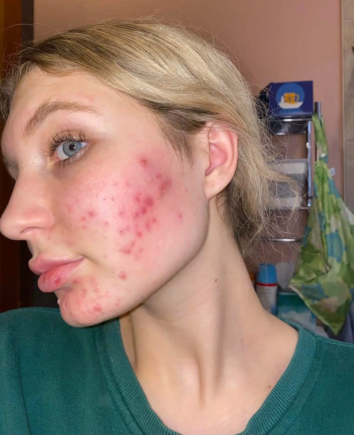 [B& A] decided to not go on antibiotics for my hormonal cystic acne due ...