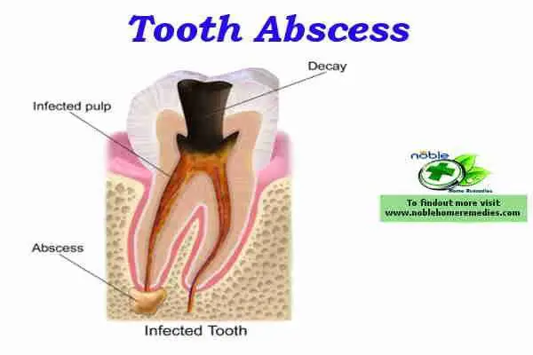 Best Natural Antibiotics Tooth Abscess: Symptoms and ...