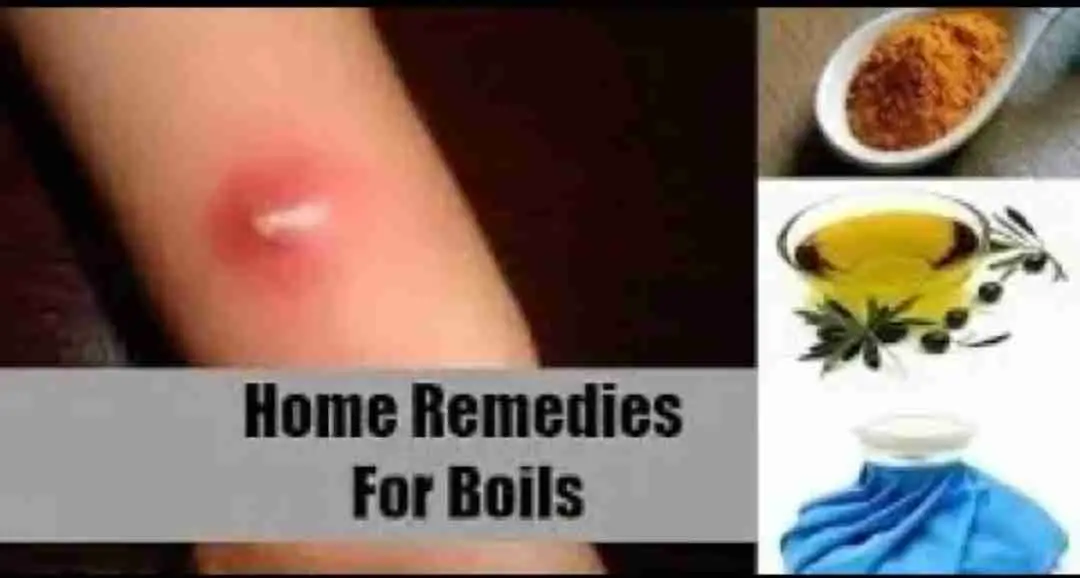 Boils :10 Quick Ways To Get Rid Of Boils On Skin.