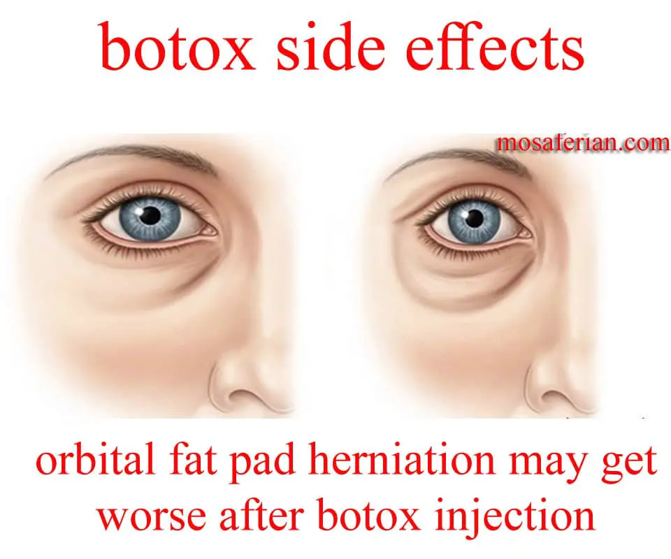 botox side effects include: Pain, swelling or bruising at the injection ...