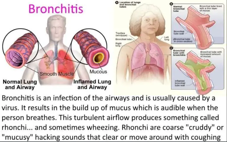 Bronchitis Or Pneumonia: Is There Obvious An Difference?