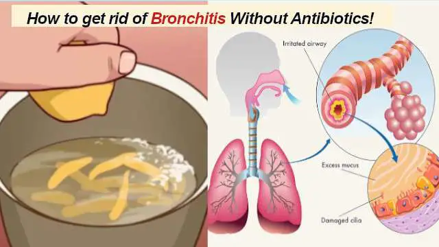 Bronchitis Prevention: How to get rid of Bronchitis Without Antibiotics!
