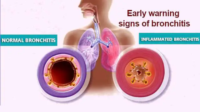 Bronchitis Prevention: How to get rid of Bronchitis ...
