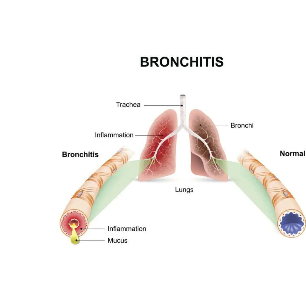 Causes of Bronchitis