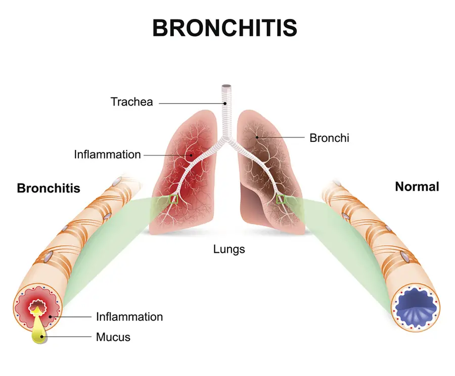 Chest Cold (Acute Bronchitis)