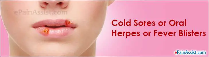 Cold Sores or Oral Herpes