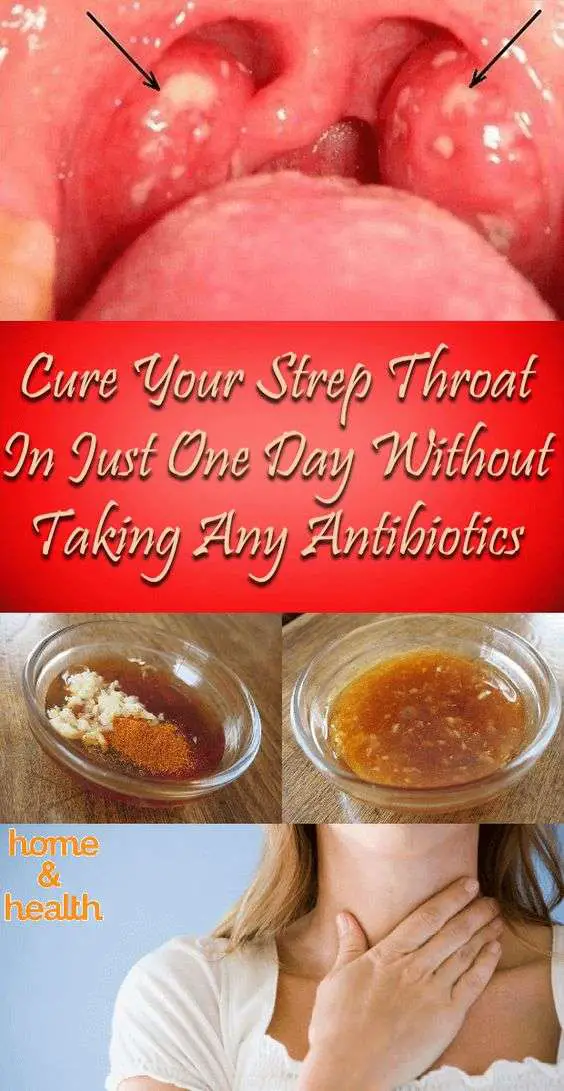 Cure Your Strep Throat In Just One Day Without Taking Any ...