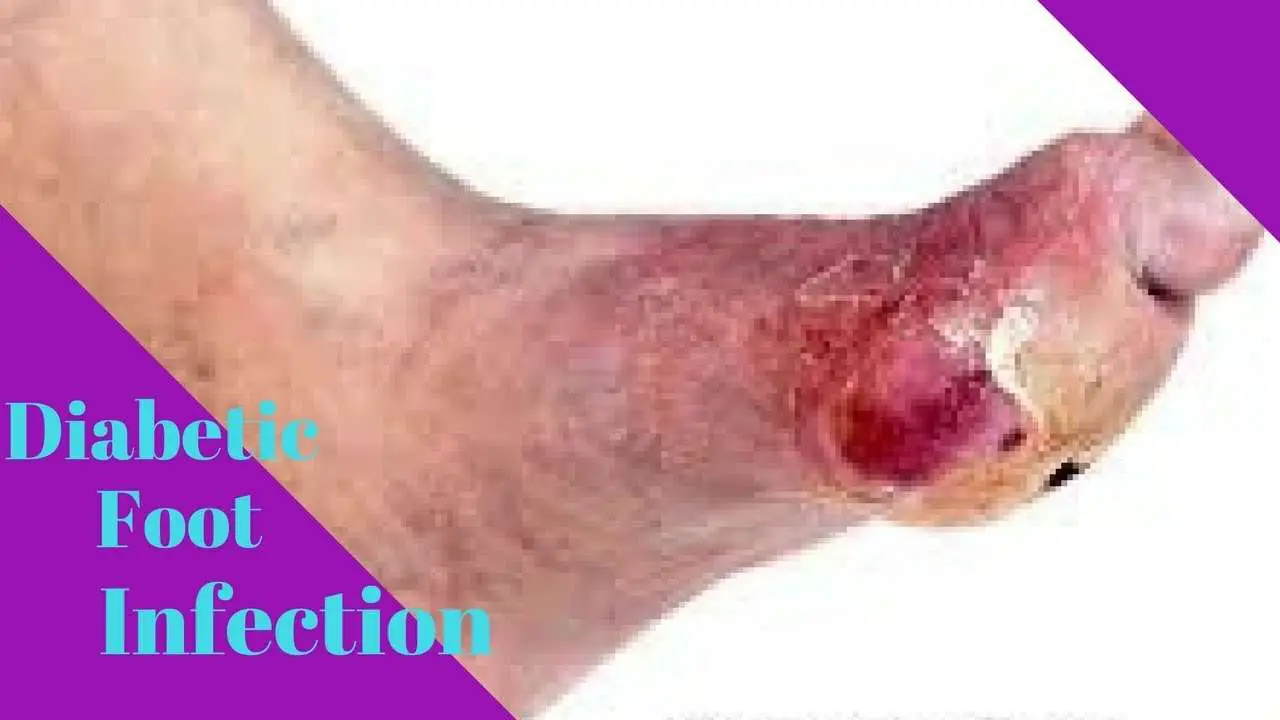 Diabetes Foot Infection