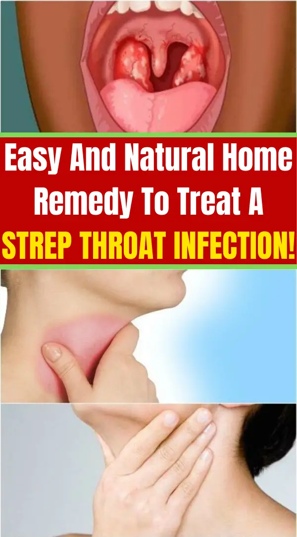 Easy And Natural Home Remedy To Treat A Strep Throat ...