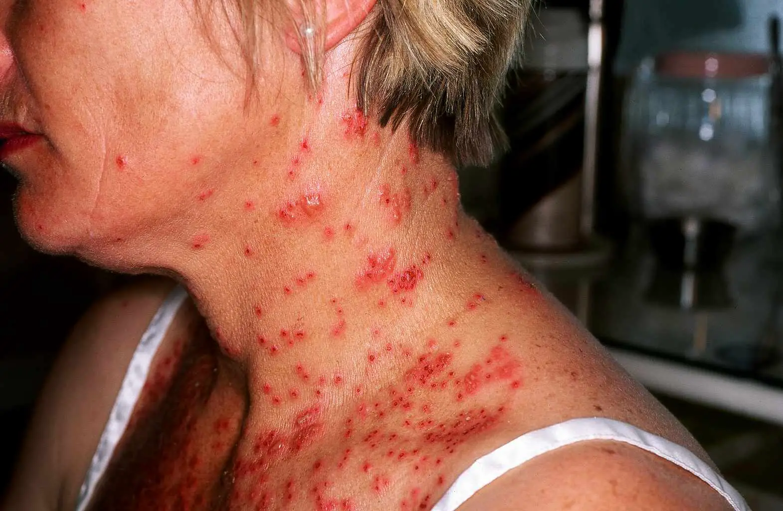 Eczema (Atopic Dermatitis): Overview and More