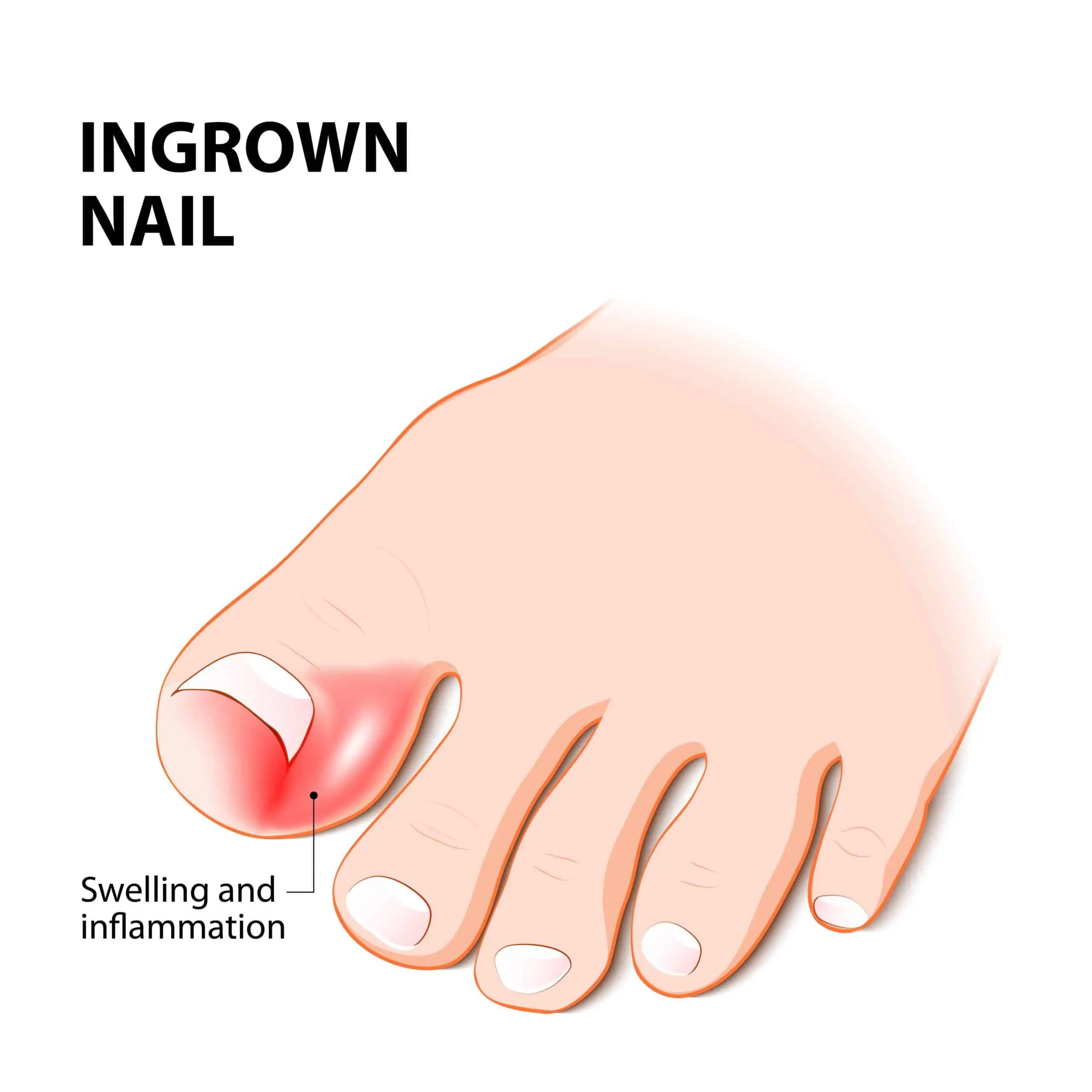 Everything you need to know about Ingrown Toenails