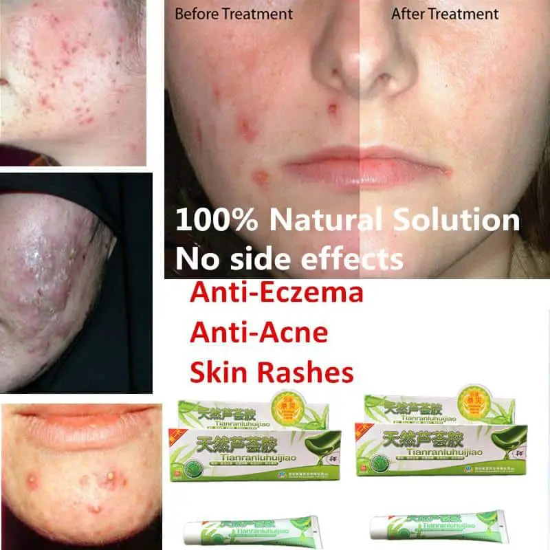 Face Rash Treatment Cream
