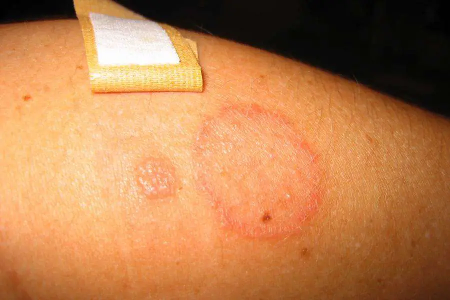 Fighting Fungus: Could CBD Help Ringworm?