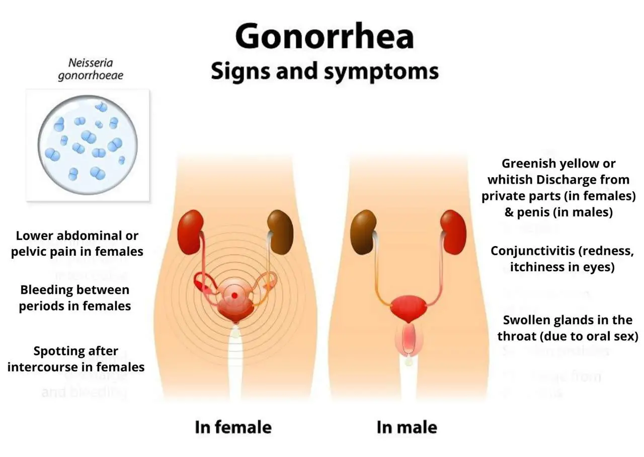 Gonorrhea Symptoms, Causes, Treatment &  Remedies ...