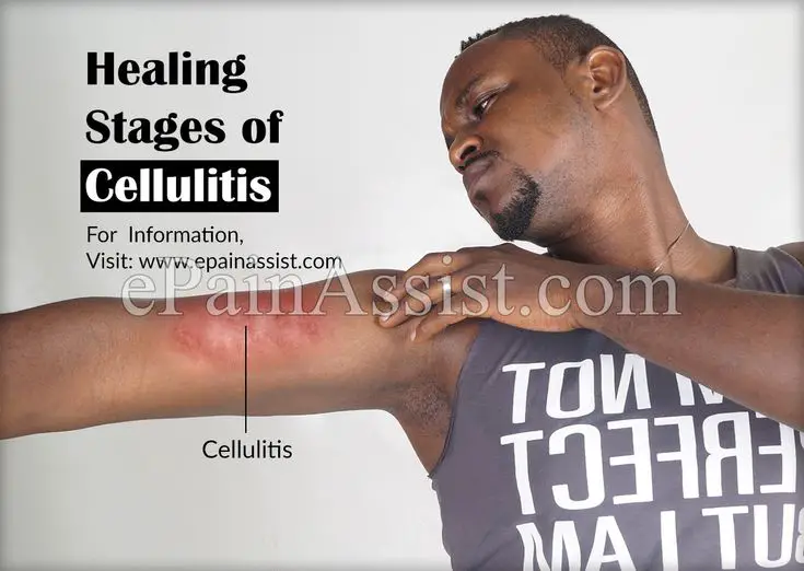 Healing Stages Of Cellulitis