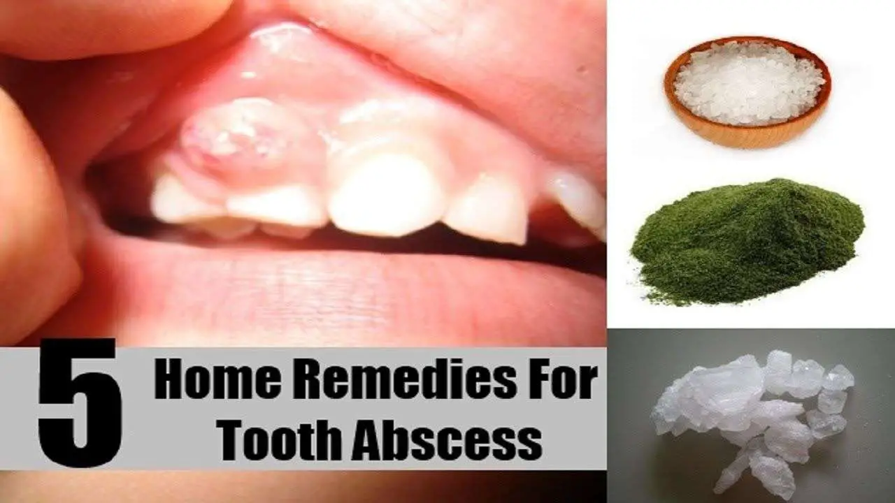 Home Remedies For Abscessed Tooth.
