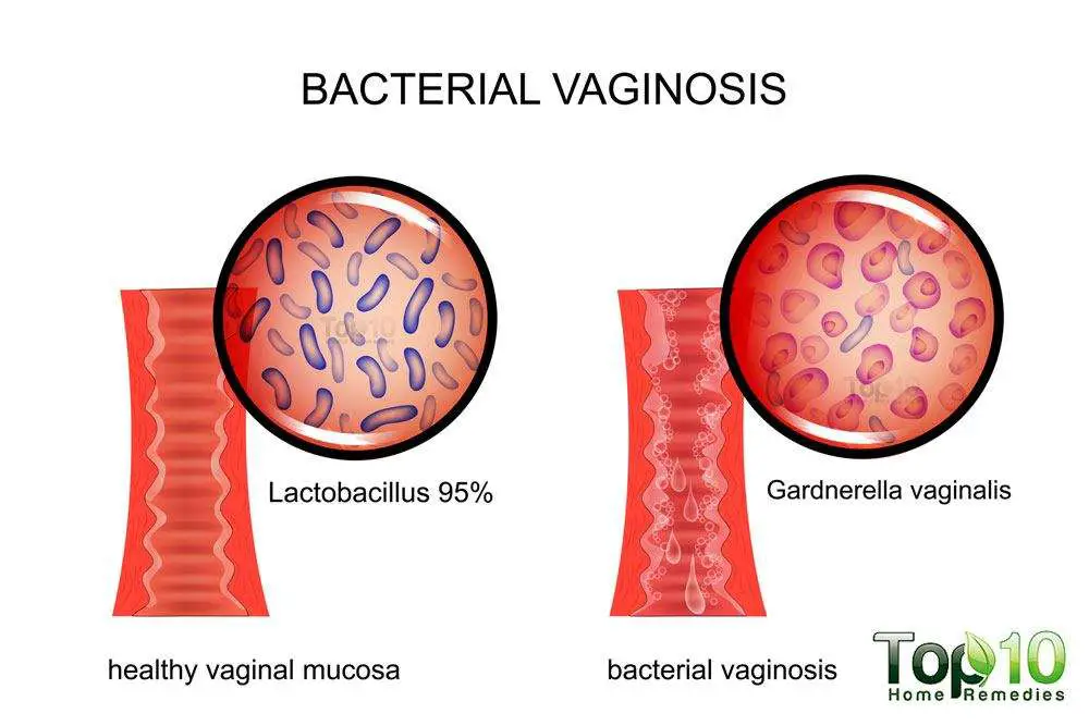 Home Remedies for Bacterial Vaginosis