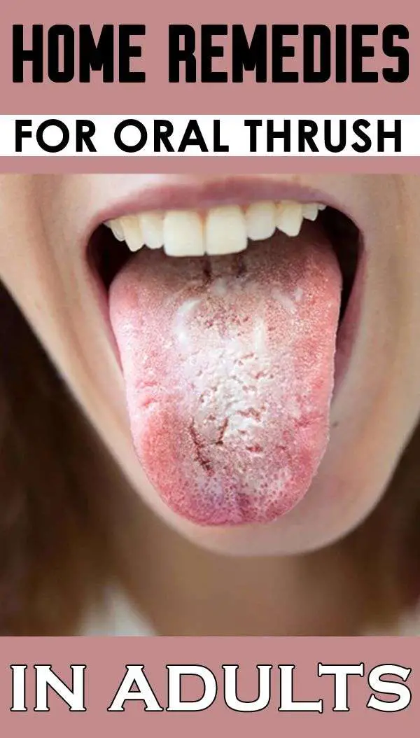Home Remedies for Oral Thrush in Adults