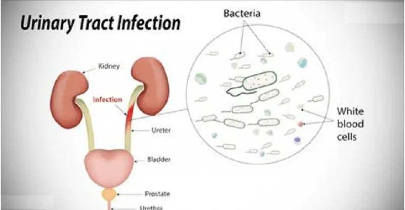 Home Remedies For Urinary Tract Infection : Human N Health