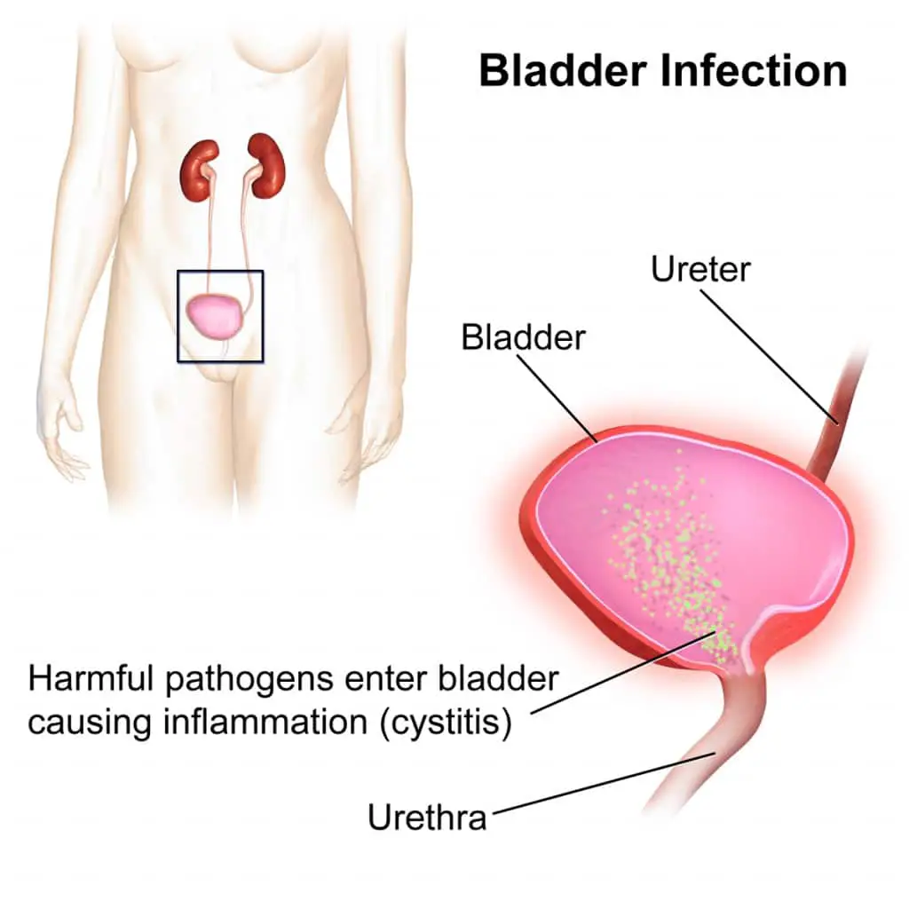 Home Remedies for UTI (Urinary Tract Infection)