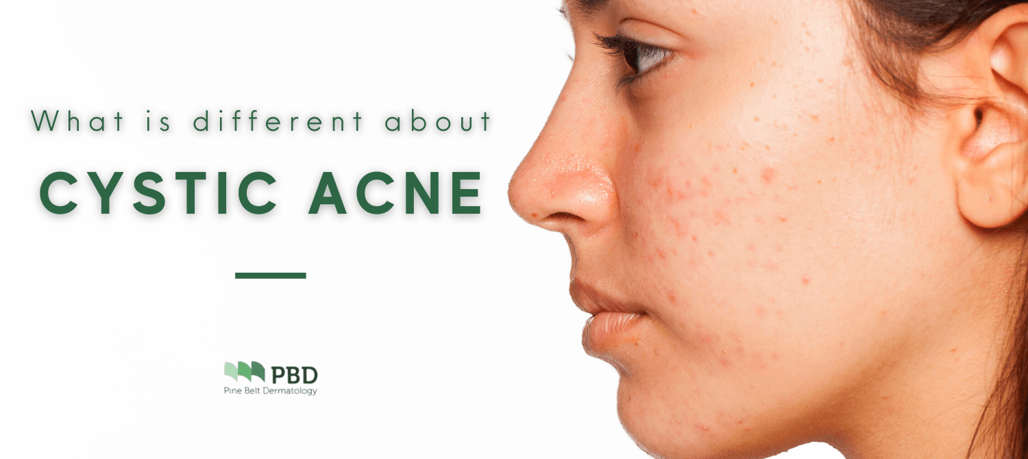 How Cystic Acne is Different from Regular Acne