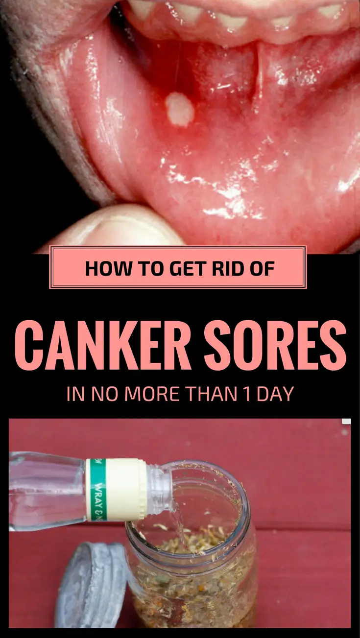 How Do I Know If A Canker Sore Is Healing