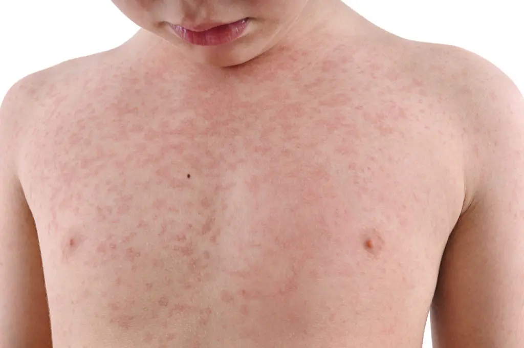 How Do You Get Rid of an Allergic Reaction Rash?