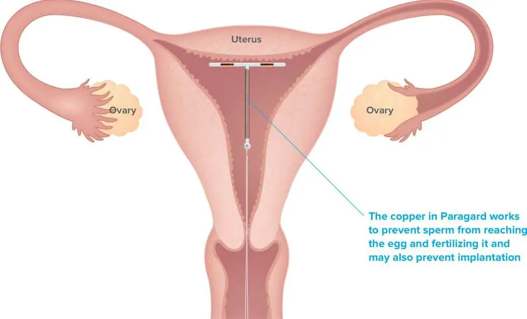 How Does A Copper Iud Work To Prevent Pregnancy ...