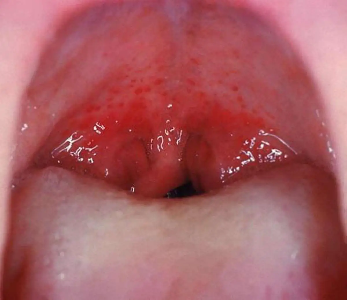 How long does strep throat last