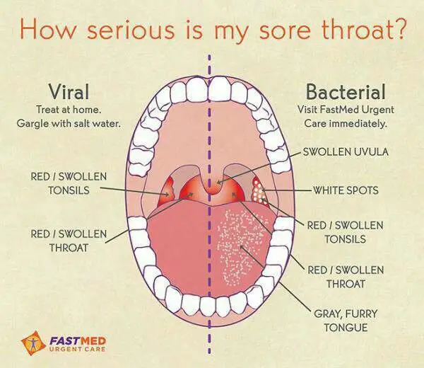 How serious is your sore throat?