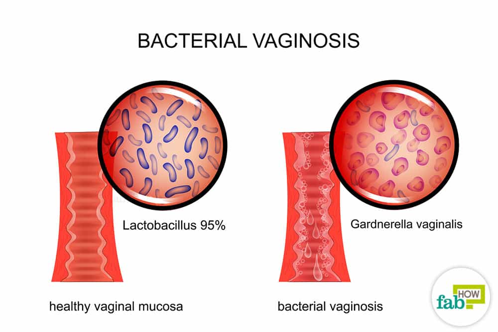 How to Get Relief from Bacterial Vaginosis with Home Remedies
