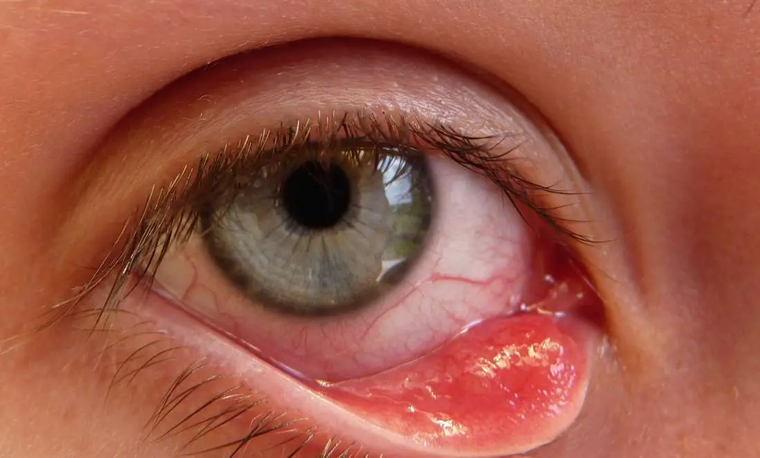 How to Get Rid of a Stye Overnight?